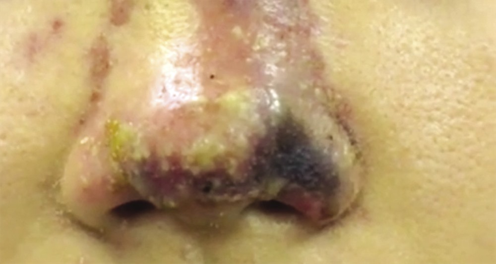 Chiếc mũi suýt hoại tử của một bệnh nhân ở Hà Nội sau khi tiêm chất làm đầy ở một thẩm mỹ viện chui. Ảnh: T.L