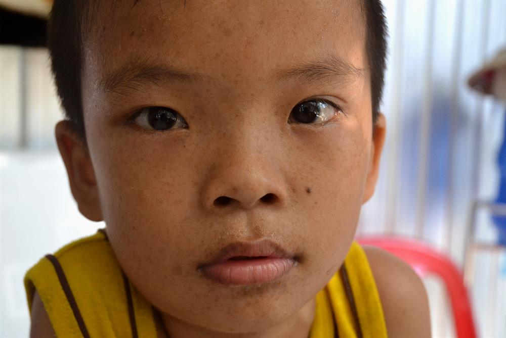 Theo kinh nghiệm của nhiều người, ngoài tật ở chân, Hiền đang mang nhiều biểu hiện của người mắc bệnh do nhiễm chất độc màu da cam.