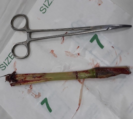 Gốc cỏ voi được lấy ra từ bụng bé Sang.