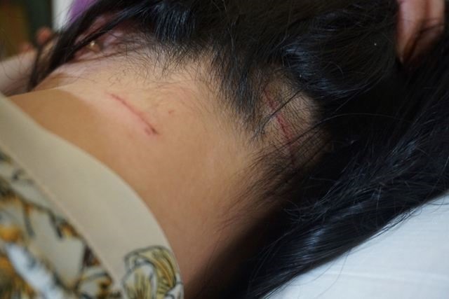 Một số vết thương mà chị Trang cho rằng bị chồng cũ dùng kéo gây ra cho mình. Ảnh: TT