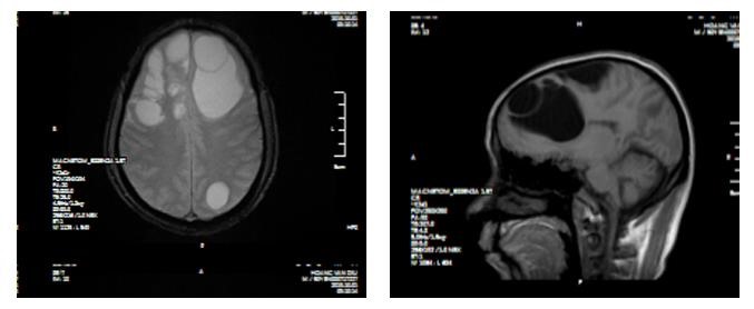 Hình ảnh chụp sọ não cho thấy ổ sán lớn nằm bên trong. Ảnh do BV cung cấp.