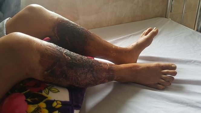 Đôi chân bà Lê Thị Lan bị bỏng hóa chất sau khi lội qua mương nước - ảnh CTV