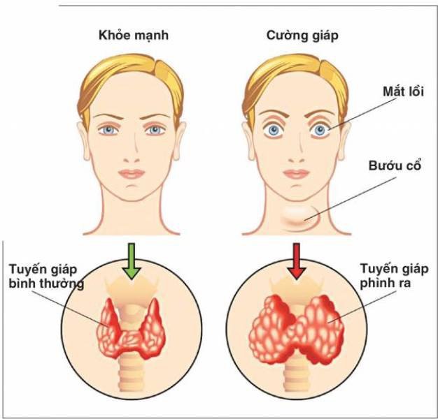 Người bị bệnh cường giáp sẽ có những thay đổi như trên. Ảnh: vinmec.com.