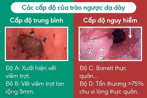 Tổng Quan Về Trào Ngược Dạ Dày