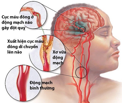 Tai biến mạch máu não có thể gây ra nhiều biến chứng nguy hiểm. Ảnh: thuocbocaocap.net.