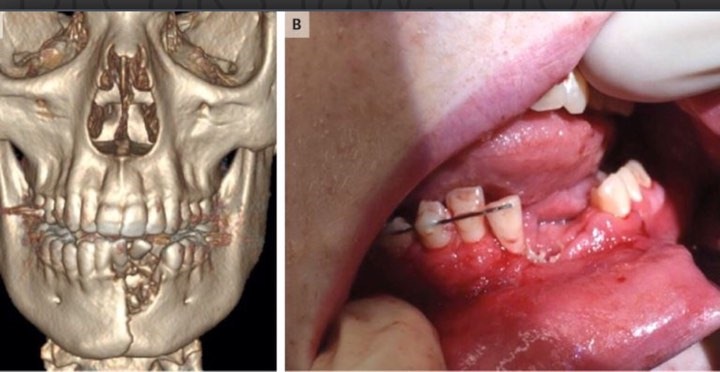 Ở trên, một hình ảnh (được tạo từ quét CT) cho thấy chấn thương hàm và răng bị hư của cậu bé (trái); và một bức ảnh của thiếu niên sáu tuần sau, khi hàm của anh ấy đã lành (phải). Cậu bé vẫn còn thiếu răng.