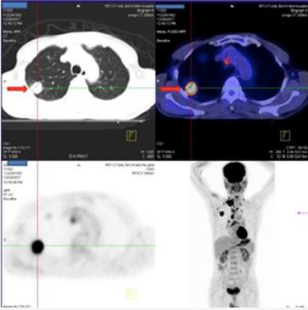 Hình ảnh khối u ở thùy trên phổi phải và hình ảnh chụp PET CT (ảnh cuối cùng bên phải) cho thấy khối u đã di căn nhiều nơi trên cơ thể.
