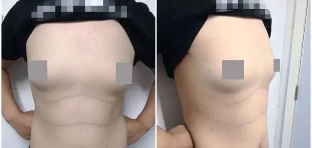 Cơ thể của Tiểu Trần gầy nhưng nhìn rõ ngực phát triển khác thường.