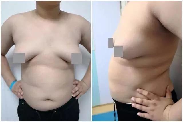 Tiểu Lý đã giảm được 20kg, nhưng phần ngực vẫn không giảm.