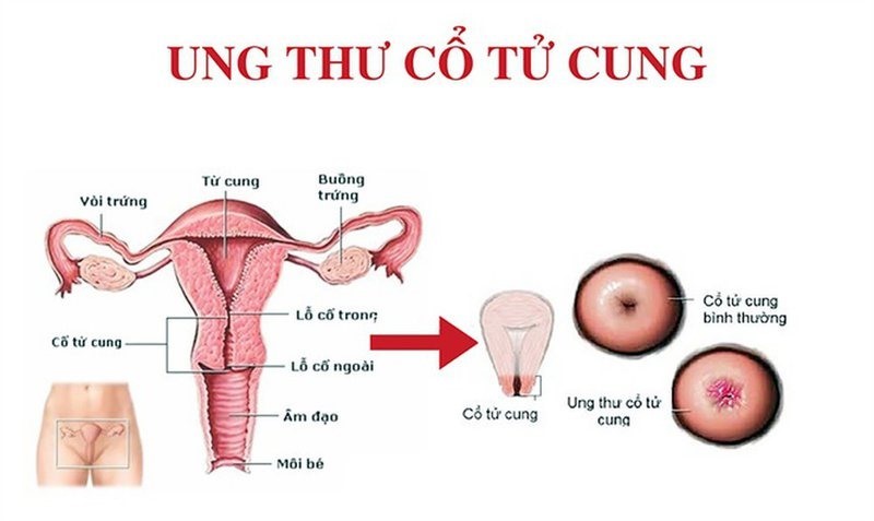 Ung thư cổ tử cung là ung thư phổ biến thứ 3 ở phụ nữ trên toàn thế giới. Ảnh: Vinmec.