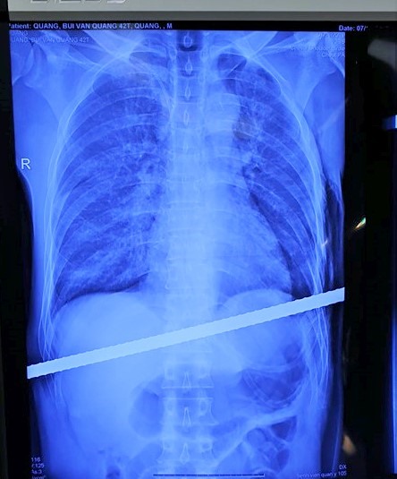 Hình ảnh thanh sắt xuyên qua gan, màng phổi 2 bên. Ảnh: BSCC