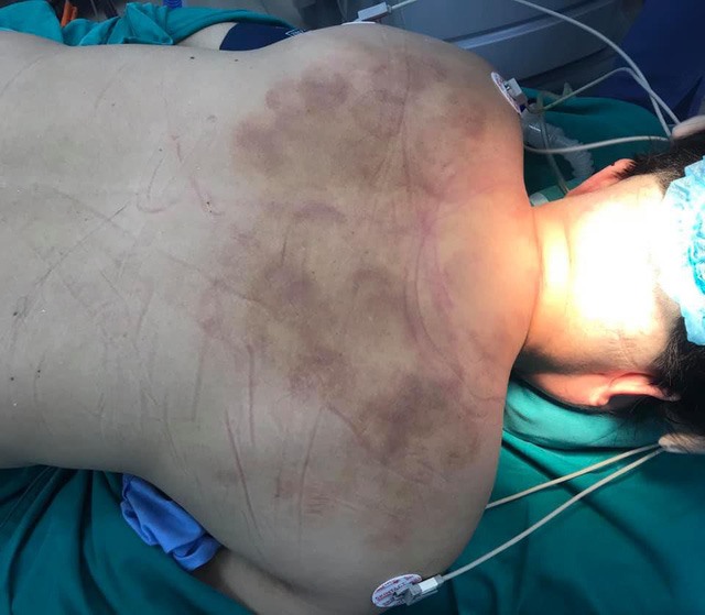Hình ảnh cổ gáy bệnh nhân bầm tím do đi đấm bóp - xoa nắn được bác sĩ chụp trước khi ca phẫu thuật. Ảnh: BSCC.