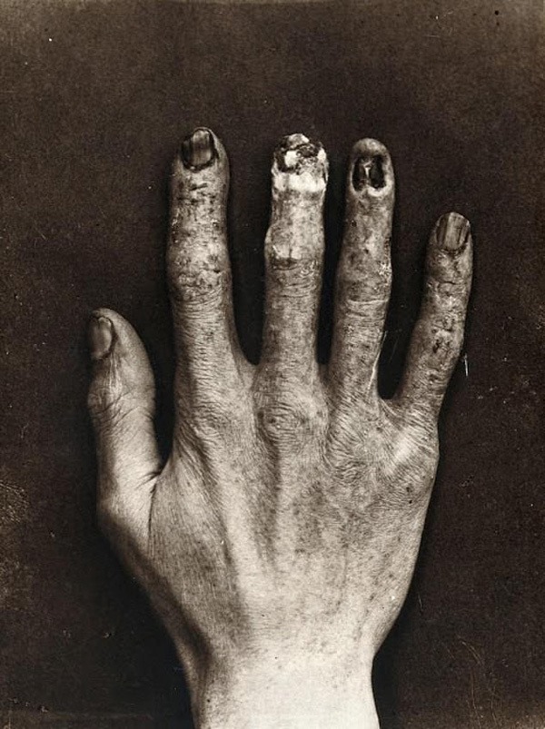 Bàn tay của Dally bị bao phủ bởi những vết thương, trông như bị bỏng sau nhiều giờ phơi bức xạ tia X trong phòng thí nghiệm của Thomas Edison.