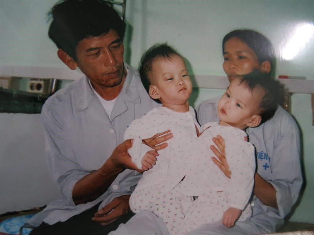 Cặp song sinh dính nhau Cúc - An được GS Nguyễn Thanh Liêm thực hiện năm 2003.
