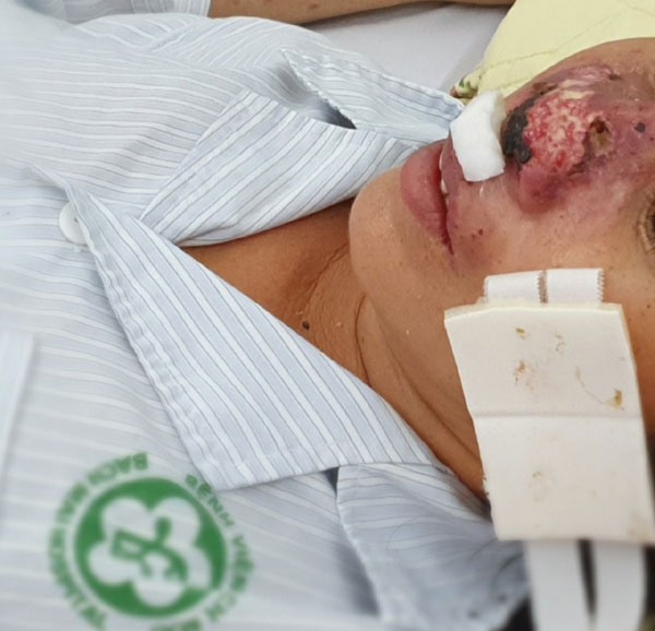Hình ảnh cánh mũi bệnh nhân bị vi khuẩn whitmore tấn công. Ảnh: M.THANH