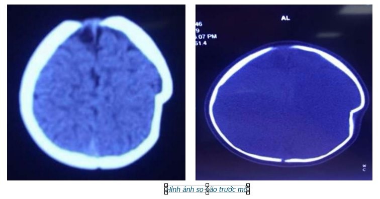 Hình ảnh sọ trước khi phẫu thuật. Ảnh do BV cung cấp.