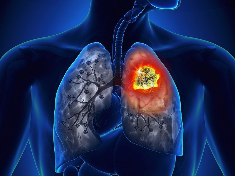 Ung thư phổi thường được phát hiện muộn. Ảnh: vinmec.com.