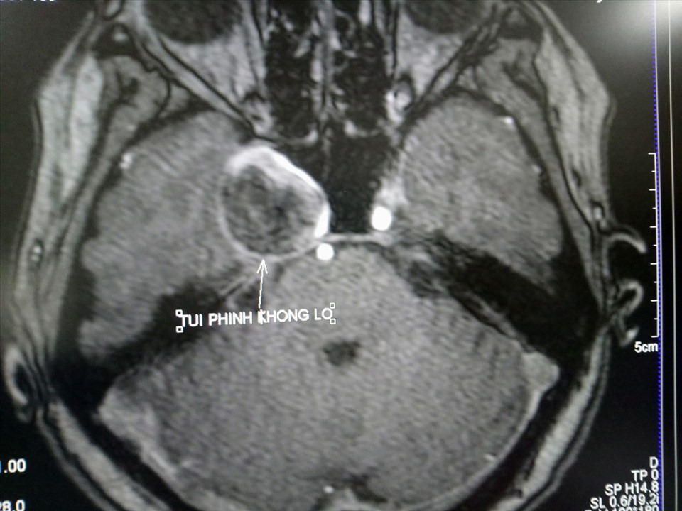 Hình ảnh chụp động mạch não bị phình rất to. Ảnh: Bệnh viện cung cấp