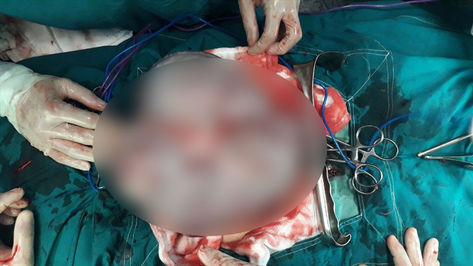 Khối u nặng 5kg chiếm hết ổ bụng của nữ bệnh nhân 49 tuổi đã được phẫu thuật thành công tại Bệnh viện đa khoa Kiên Giang. Ảnh: Bệnh viện cung cấp