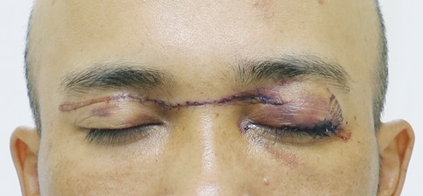 Vết thương sau khi được xử trí khâu tạo hình sụn mi mắt trái và khâu vết thương mặt. Ảnh bệnh viện cung cấp.