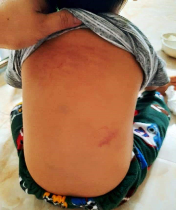 Cháu bé bị bạo hành với nhiều vết bầm tím ở phần lưng. Ảnh: NT