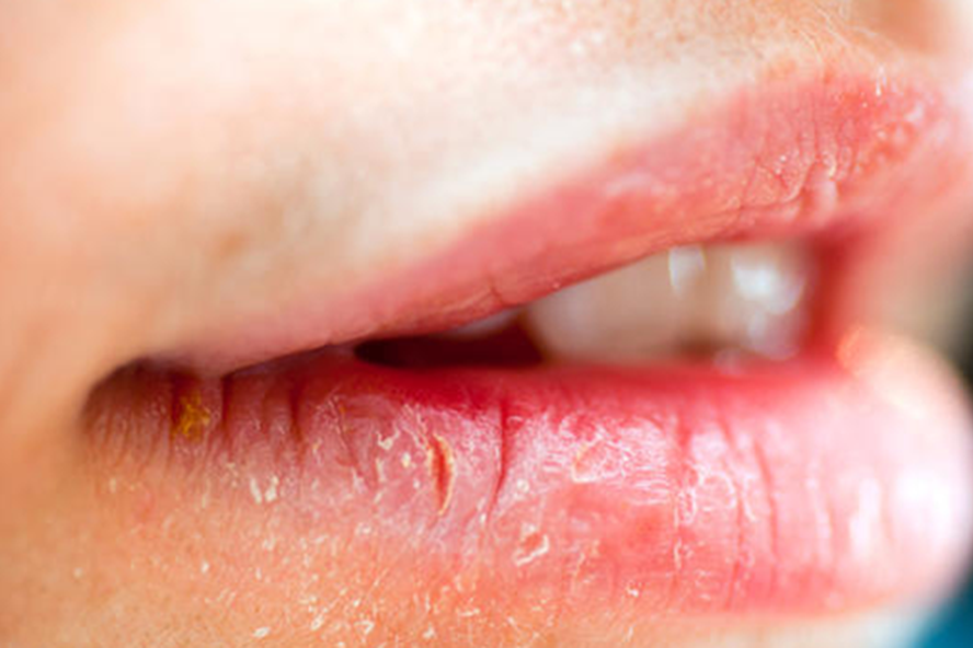 Nếu bạn bị khô và nứt nẻ môi, đây là cách bạn chữa lành chúng. Ảnh: LĐ.