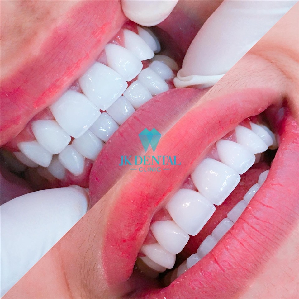 Hàm răng trắng ngần, đều tăm tắp đem đến nụ cười tươi và tự tin (Nguồn: JK Dental).