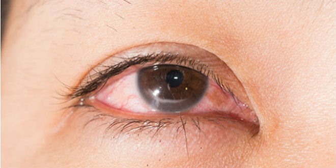 Bệnh viêm giác mạc gây ảnh hưởng lớn tới sinh hoạt hàng ngày của người bệnh. Nếu không được điều trị kịp thời, có thể gây mù lòa mắt. Ảnh: Bệnh viện mắt TP HCM