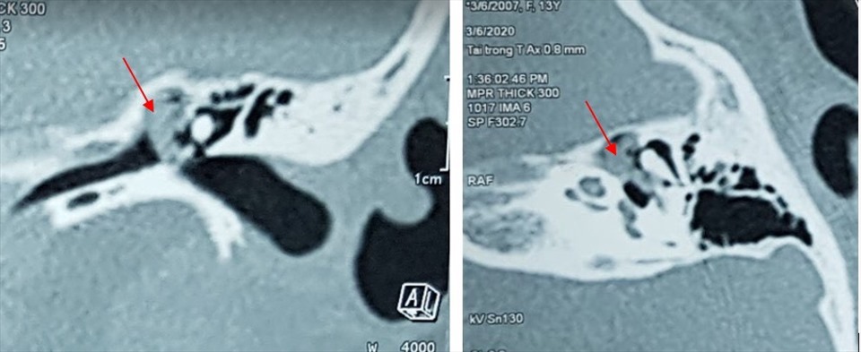 Hình ảnh Cắt Lớp Vi Tính: khối cholesteatoma ăn mòn xương con và lan rộng trong tai giữa trái. Ảnh:BVCC
