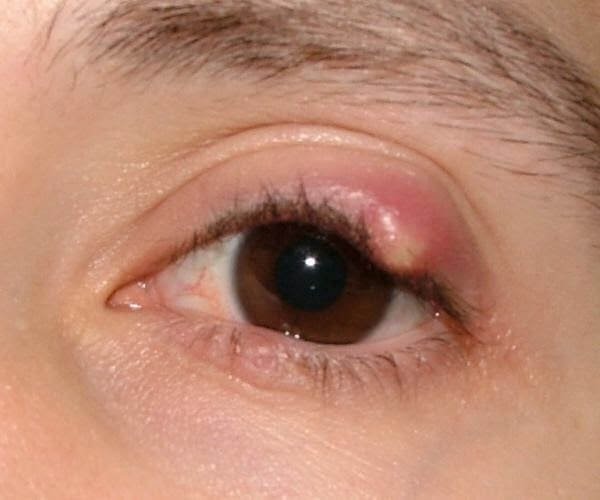 Chắp và lẹo là những bệnh thường gặp ở mí mắt, ảnh hưởng nhiều tới sinh hoạt của người mắc. Ảnh: vinmec.com