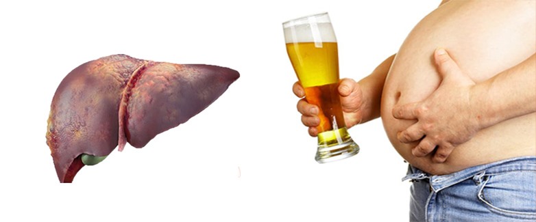 Người bị gan nhiễm mỡ cần tránh xa bia, rượu. Đồ họa: Hồng Nhật