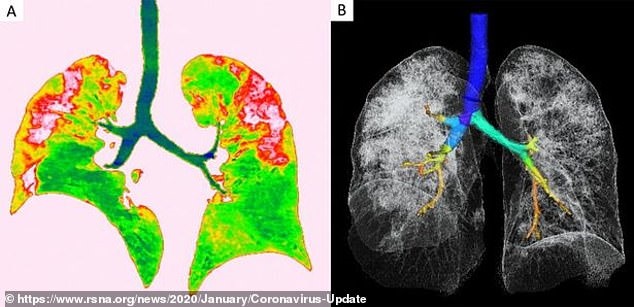 Các tổn thương ống kính mờ màu đỏ ở ảnh bên trái và ảnh 3D phổi và khí quản của bệnh nhân 54 tuổi. Ảnh: RSNA.