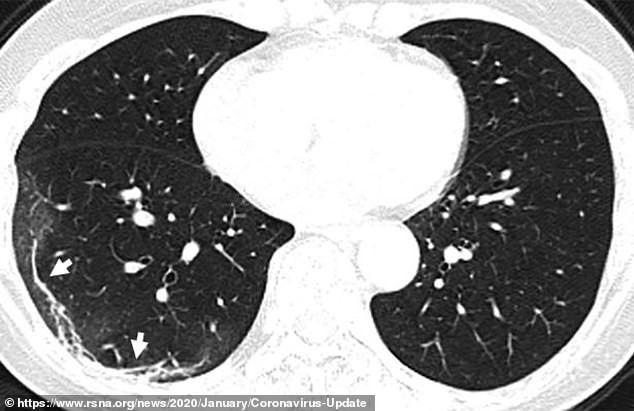 Chụp cắt lớp vi tính phổi của nữ bệnh nhân 45 tuổi. Ảnh:
