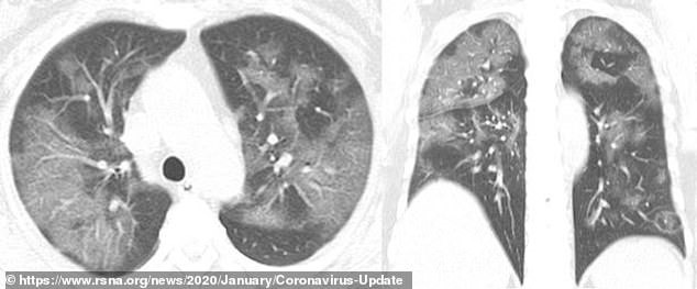 X-quang phổi của người phụ nữ 54 tuổi bị viêm phổi sau khi đến Vũ Hán. Ảnh: