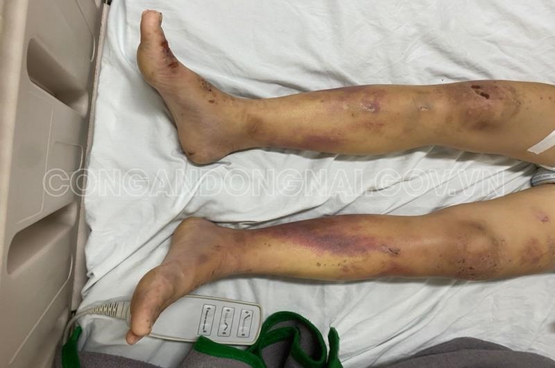Thương tích của nạn nhân P.T.T.T. (24 tuổi) cấp cứu tại Bệnh viện đa khoa Đồng Nai vào ngày 11.3_Ảnh: CACC