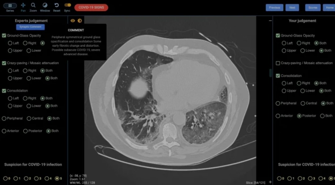 Hình ảnh chụp vi tính cắt lớp chỉ ra phổi của bệnh nhân nhiễm COVID-19 trong tình trạng nguy hiểm . Ảnh: The Age