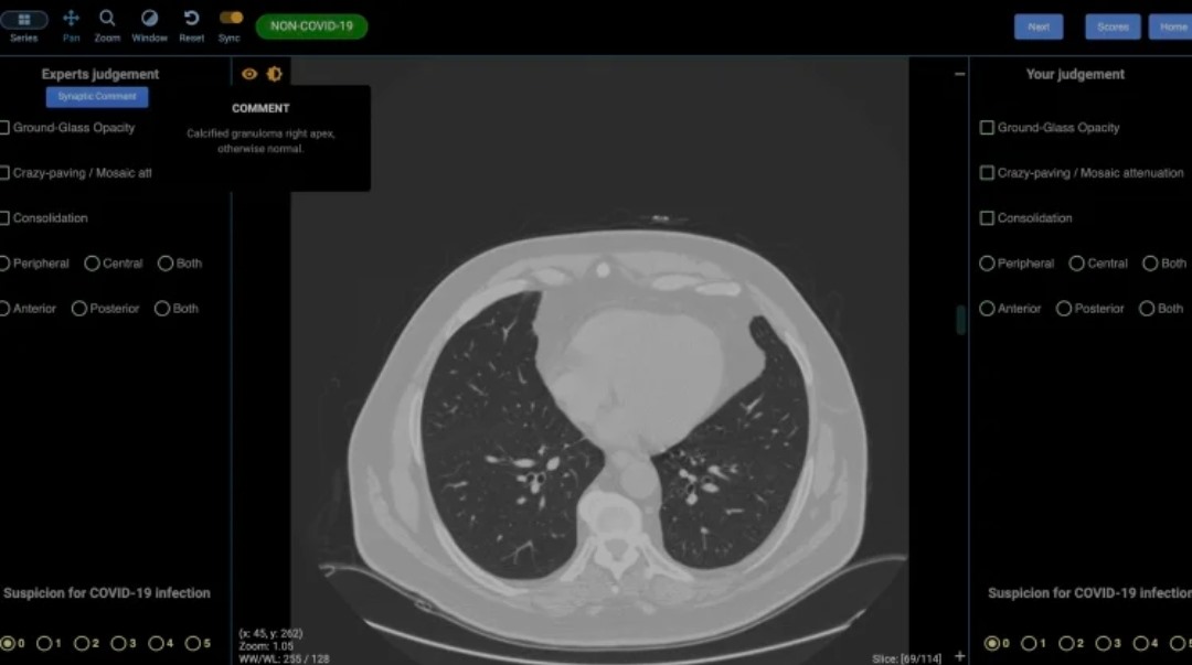 Hình ảnh chụp cắt lớp vi tính phổi không có dấu hiệu mắc COVID-19. Ảnh: The Age