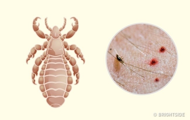 Vết cắn côn trùng không chỉ gây đau đớn mà còn có thể mang lại những tác hại khác cho sức khỏe của chúng ta. Xem hình ảnh liên quan để hiểu rõ hơn về cách xử lý và cách phòng tránh những vết cắn không mong muốn này.