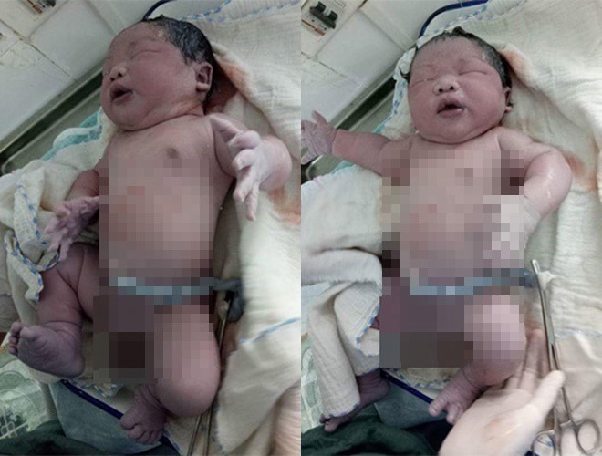 Ngày 14.10.2017, tại Bệnh viện Đa khoa huyện Vĩnh Tường, Vĩnh Phúc, sản phụ Nguyễn Thị Kim Liên hạ sinh một bé trai nặng 7,1kg bằng phương pháp sinh mổ.