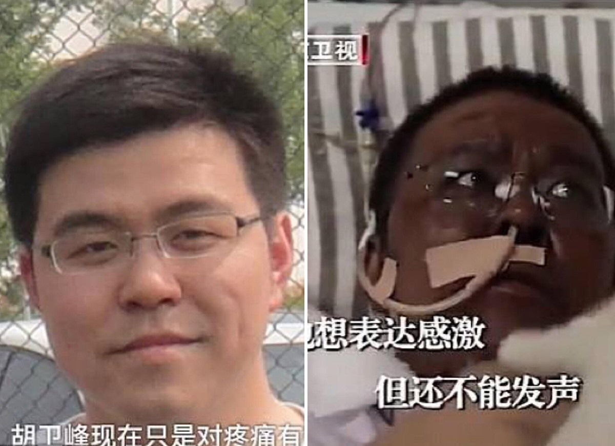Bác sĩ Hu Weifeng trước và sau khi mắc COVID-19. Ảnh: Pear Video/Beijing TV Station