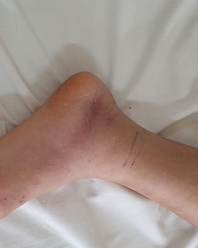 Hình ảnh vết rắn cắn mặt trong bàn chân trái của bệnh nhân. Ảnh: Bệnh viện cung cấp.
