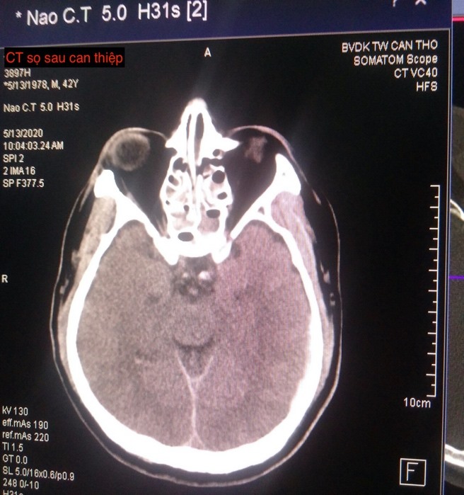 Hình ảnh CT sọ sau khi can thiệp. Ảnh: S.H