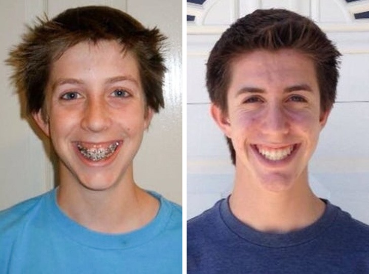 4 năm niềng răng và đây là bức ảnh trước và sau khi tháo niềng của chàng trai này. Có thể thấy chàng trai đang rất hạnh phúc và tự tin với nụ cười của mình. Ảnh: Brightside