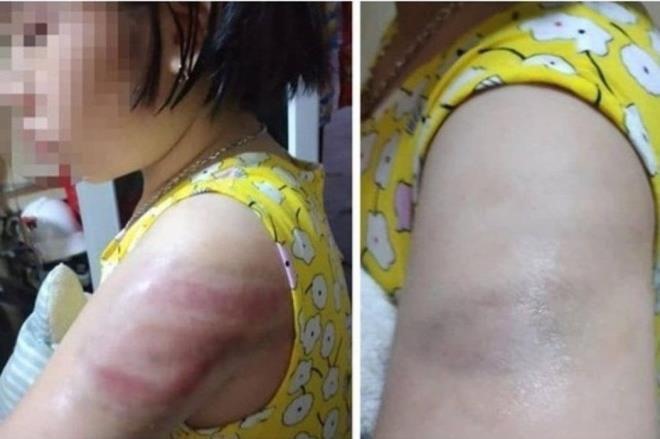 Học sinh ở Nam Định bị cô giáo đánh bầm tay vì làm bài tập chậm, thiếu tập trung.  Ảnh: PHCC