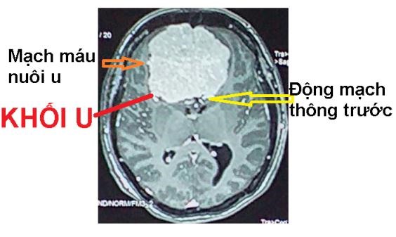 Hình ảnh U màng não của bệnh nhân. Ảnh: Bệnh viện cung cấp.