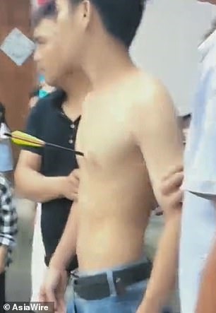 Nam thanh niên Trung Quốc bị mũi tên xuyên thủng phổi và gãy 1 xương sườn. Ảnh: Mail.