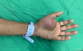 Hình ảnh bướu máu trên tay bệnh nhân khi nhập viện. Ảnh: BV cung cấp