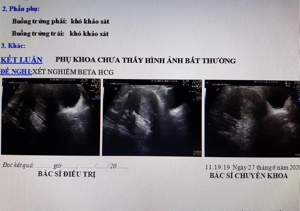 Kết quả siêu âm của chị D. Ảnh: Bác sĩ Nguyễn Bửu Thuyên