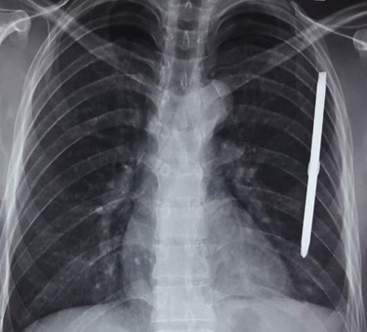 Hình ảnh X - quang cho thấy tuốc nơ vít đâm xuyên phổi bệnh nhân.