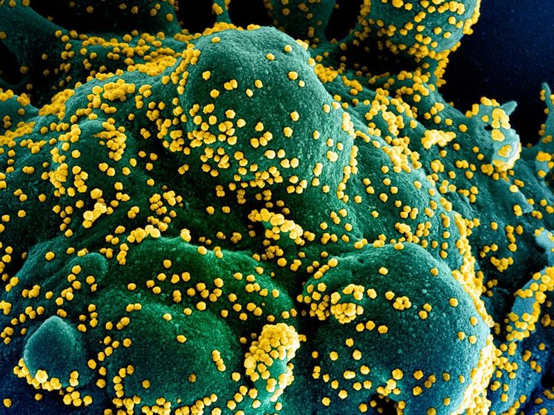 Một tế bào (xanh dương/xanh lục) bị nhiễm nặng các hạt virus SARS-CoV-2 (màu vàng), được phân lập từ bệnh nhân và chụp tại NIAID, Fort Detrick, Maryland, Mỹ: NIAID/AFP.